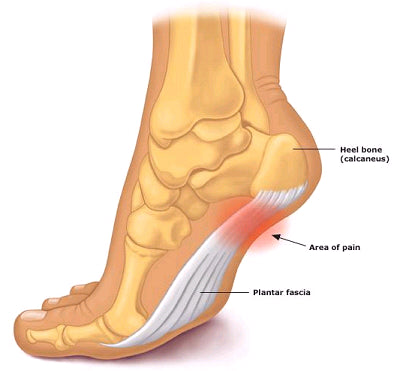 Heel Pain causes and treatment